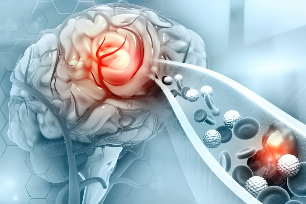 Endovascular Neurosurgery